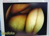 SMITH & NEPHEW 3626 DYONICS Video