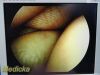 SMITH & NEPHEW 3626 DYONICS Video