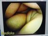 SMITH & NEPHEW 3626 DYONICS Video