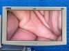 KARL STORZ Spies Tower TC200, TC300, TH100, Thermoflator Laparoscope