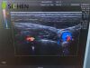 GE 11L-D Ultrasound Transducer