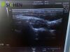 GE 11L-D Ultrasound Transducer