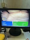 OLYMPUS BF-1TQ180 Bronchoscope