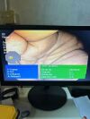 OLYMPUS PCF-Q180AL Colonoscope