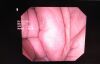 OLYMPUS GF-UCT180 Gastroscope