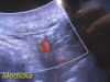 PHILIPS 3D6-2 Volumetric 3D-4D Convex Array Ultrasound Probe *TESTED*/ Ultrasound Transducer