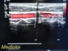 PHILIPS L8-4 Linear Array Ultrasound Transducer