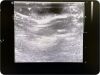 PHILIPS L15-7io  Linear Array Hockey Stick Ultrasound Probe Transducer