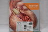 STRYKER 81043 Medpor Titan MTB Left Large 3D Orbital Floor Implant, 36 x 37 x 17 mm Size