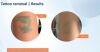 ASCLEPION PicoStar Laser - YAG