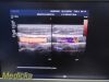 PHILIPS L17-5 Linear Array Ultrasound Transducer