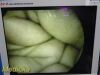 ARTHREX AR-3351-5530 HD , 5.5mm x 300mm, 30° Autoclavable, Case~ Laparoscope