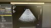 PHILIPS CX MC7-2 Micro Convex Compact Ultrasound Transducer