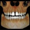 PREXION Eclipse XP77 2D+3D+CBCT Pan 11.3x7.5 FOV with PC, Warranty Dental X-Ray