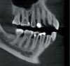 PREXION Eclipse XP77 2D+3D+CBCT Pan 11.3x7.5 FOV with PC, Warranty Dental X-Ray