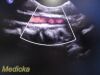 PHILIPS X6-1 Matrix,(Ref 453561247501) *TESTED* ~ Ultrasound Transducer