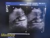 PHILIPS X6-1 Matrix,(Ref 453561247501) *TESTED* ~ Ultrasound Transducer