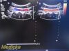 PHILIPS C5-1 Convex Array Ultrasound Transducer