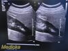 PHILIPS C5-1 Convex Array Ultrasound Transducer