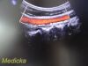 PHILIPS C5-1 Convex Array (Ref # 453561224465) ~ Ultrasound Transducer