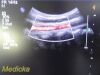 PHILIPS C5-2 Curved Array Ultrasound Transducer
