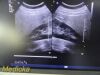 PHILIPS C5-2 Broadband Curved Array Ultrasound Transducer