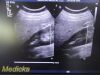 PHILIPS C5-2 Broadband Curved Array Ultrasound Transducer