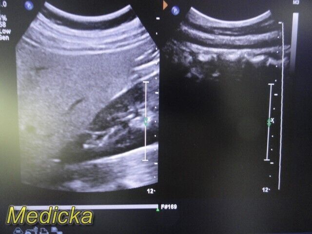 PHILIPS C5-1 Broadband Curved Array Ultrasound Transducer