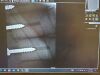 ARIBEX Nomad Pro Handheld Dental Intraoral X-Ray