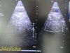 PHILIPS X7-2 Ref 453561192603 Matrix Array Ultrasound Transducer