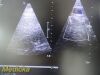 PHILIPS X7-2 Ref 453561192603 Matrix Array Ultrasound Transducer