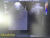 PHILIPS X3-1 P/N 21715A xMatrix Phased Array Ultrasound Transducer