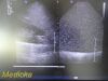 PHILIPS X3-1 P/N 21715A xMatrix Phased Array Ultrasound Transducer