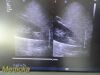 PHILIPS X3-1 P/N 21715A xMatrix Phased Array Ultrasound Transducer