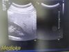 PHILIPS C5-1 Broadband Convex Array Ultrasound Transducer