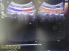 PHILIPS C5-1 Broadband Convex Array Ultrasound Transducer