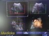 PHILIPS 3D9-3v Convex Array 3D Endocavity Ultrasound Transducer