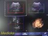 PHILIPS 3D9-3v Convex Array 3D Endocavity Ultrasound Transducer