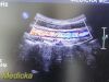 PHILIPS C9-4 P/N 453561212363 Convex Array Ultrasound Transducer