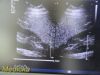 PHILIPS S4-1 Broadband Phased Array Ultrasound Transducer