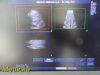 PHILIPS S4-1 Broadband Phased Array Ultrasound Transducer