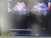 PHILIPS S4-1 Broadband Phased Array Ultrasound Transducer