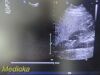 PHILIPS S4-1 Phased Array Ultrasound Transducer