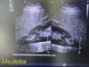 PHILIPS S4-1 Phased Array Ultrasound Transducer