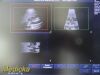 PHILIPS S4-1 Phased Array Ultrasound Transducer