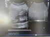 PHILIPS C5-2 Ergo Convex Array Ultrasound Transducer