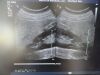 PHILIPS C5-2 Ergo Convex Array Ultrasound Transducer