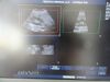 PHILIPS C5-2 Ergo Convex Array Ultrasound Transducer