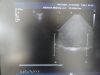 PHILIPS X3-1 P/N 21715A xMatrix Phased Array Ultrasound Transducer