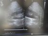 PHILIPS X3-1 P/N 21715A xMatrix Phased Array Ultrasound Transducer